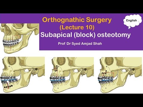 Subapical (block) osteotomy | Orthognathic Surgery | Oral & Maxillofacial Surgery | Syed Amjad Shah
