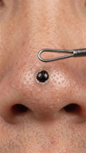 The biggest blackhead on his nose 😳 Giant blackhead removal with a comedone extractor #oddlysatisfying #blackheadsremoval #pimplepop #extraction #giantblackhead