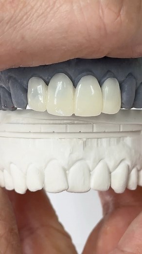 Before and After Temporary Provisional Bridge! Case from Dr. Alexander Cox in New York! Scarsdale Smiles - Dr. Alex Cox | Luke Kahng