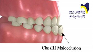 Class III skeletal malocclusion - Dr Jamilian
