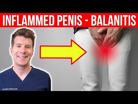 Penis pain and inflammation? Balanitis Explained: Symptoms, Causes, and Treatment Options