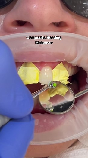 Dr Richard using composite bonding on 8 upper teeth to improve the position, lengths and shape of the teeth with no drilling to the natural tooth 😍