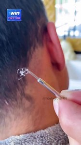 Satisfying Extraction of Ingrown Hair and Blackhead