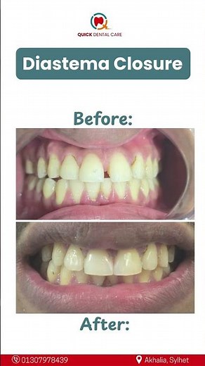Close Teeth Gap in Just 30 Minutes | Diastema Closure Before & After