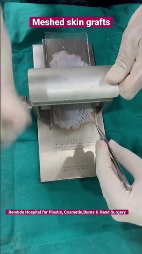Tips:Meshed Skin grafting technique for skin graft expansion to save donor area in huge wounds cover