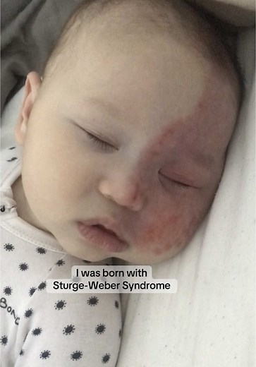 Rare Disease Day 2024: Awareness for Sturge-Weber Syndrome