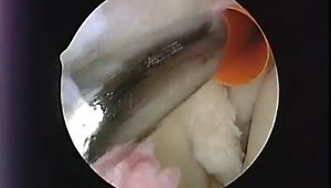 Subpectoral Open Biceps Tenodesis using Interference Screw