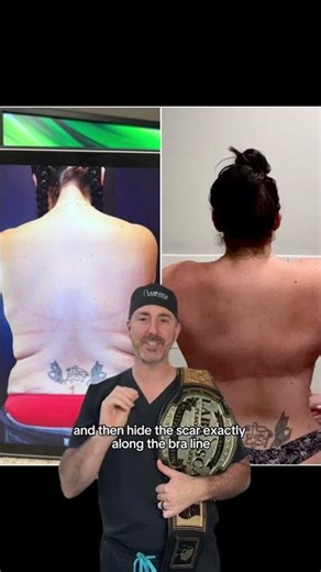 What Is a Bra Line Back Lift?