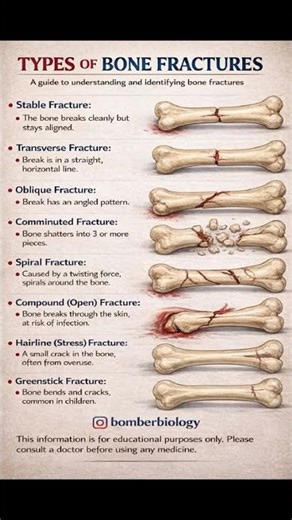 type of bone fractures ⚠️