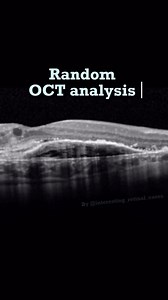 퐷푟. 푆푡푒́푝ℎ푎푛푒 퐹푖푡표푢푠푠푖 , 푀푖푎푚푖, 퐹푙표푟푖푑푎 on Instagram: "Findings on this scan are: 1- CNVM with adjacent leakage 2- Drusen 3- Exudates 4- intraretinal fluid #retina #ophthalmology #optometry #optometrist #ophthalmologist #oftalmologia #optometrystudent #oftalmologista #optometria"