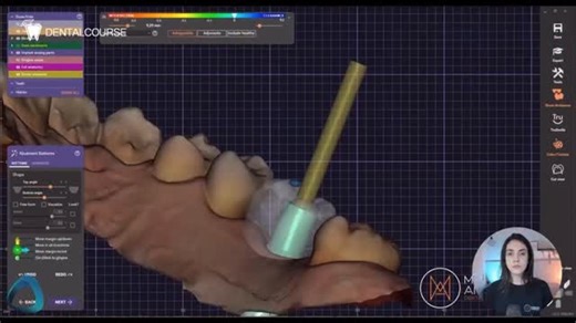 Iranian Dental Course on Instagram‎: "⁨ برای دریافت ویدیو کامل ، پیج دنتال کورس را فالو کرده و عدد “ 8 “ را کامنت کنید. ‪@dental_course‬‪@dental_course‬se در طراحی دیجیتال کراون پیچ‌دار، با ترکیب اسکن داخل‌دهانی، داده‌های CBCT و نرم‌افزارهای پیشرفته سه‌بعدی، امکان کنترل دقیق مسیر پیچ، ارتفاع اباتمنت و پروفایل اورژانسی فراهم می‌شود. این رویکرد منجر به دقت بالاتر، کاهش خطاهای پروتزی، افزایش پیش‌بینی‌پذیری درمان و ارتقای نتیجه نهایی زیبایی و فانکشن خواهد شد. پیج Dental Course را فالو کنید و هر موضو