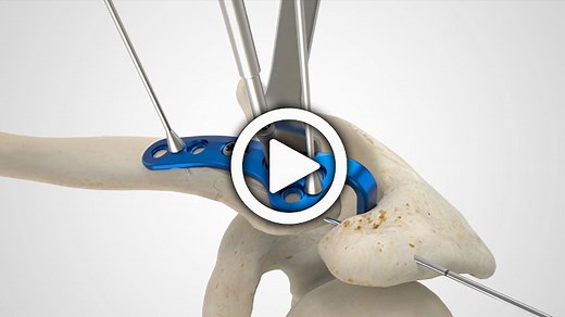 Clavicle Hook Plate Surgical Technique Overview Animation