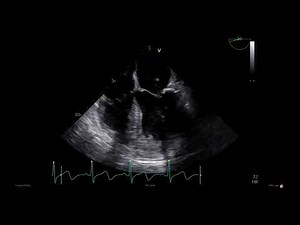 Minimally Invasive Removal of a Left Atrial Mass • Video • MEDtube.net