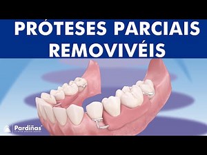 Próteses parciais removivéis ©