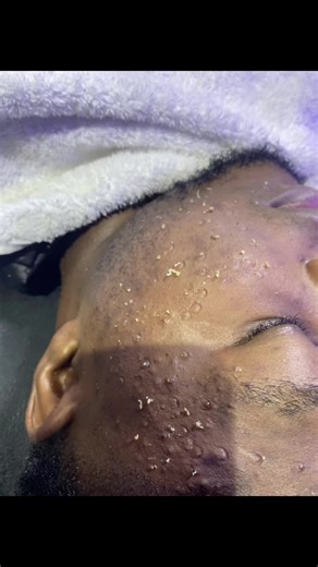 Stop going about with that rough Face Come let us give You a nice treat, take out all the pimples in your face and take good of the hyperpigmentation, and I also sell good corian products for Your face too