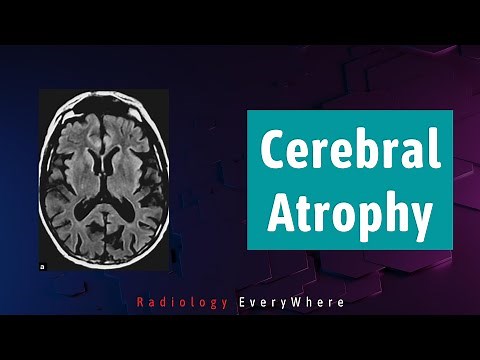 Cerebral Atrophy Causes Radiology tutorials | 1000 cases in 100 days | 3/1000 | Radiology Everywhere