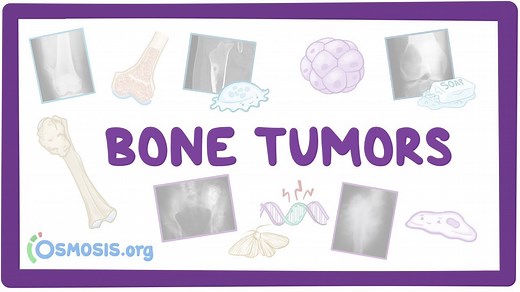 Bone tumors: Video, Causes, & Meaning | Osmosis
