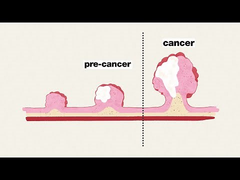 Colorectal cancer screening