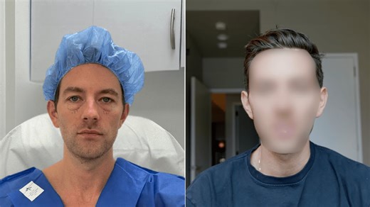 Eye bag removal surgery: What you should know