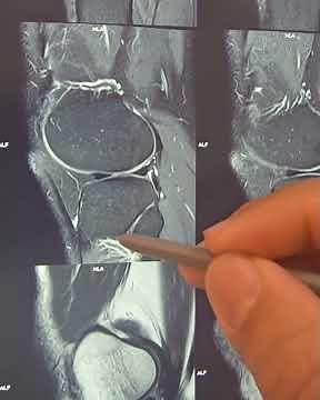 how to read the knee MRI