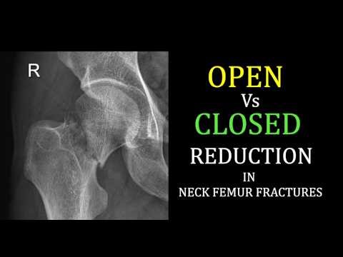 OPEN vs CLOSED Reduction in Neck Femur Fractures