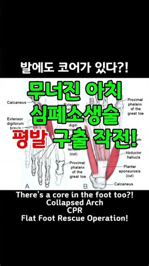 평발 그대로 두지마세요 무너진 아치 살리는 진짜 평발운동