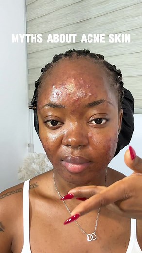 3 weeks on Acnotin🎉 Read Caption 🫧🤍⤵️ 1. Myth: Acne is caused by poor hygiene. Reality: While keeping your skin clean is important, acne is not caused by dirt or poor hygiene. 2. Myth: Acne is contagious. Reality: You can’t catch acne from someone else. 3. Myth: Popping pimples helps them heal faster. Reality: Popping pimples can lead to infection, scarring, and longer healing times. 4. Myth: Acne is a sign of poor health. Reality: Acne is not a reflection of your overall health. I hope this 