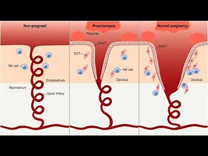 Preeclampsia Pathophysiology