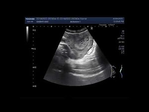 Ultrasound Video showing Hydatidiform mole also called Molar pregnancy.