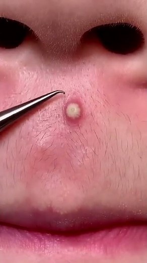 Epic Blackheads. Super pops. Zit Pops. Blackheads Removal. Enjoy Popaholics!💋 #525