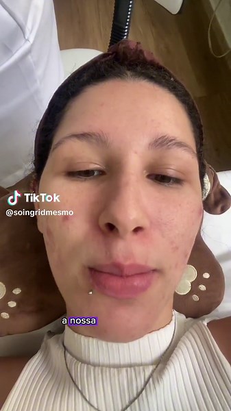 parte 1 da limpeza de pele veio aiii #acnetreatment #peleacneica #cravos #espinhasinflamadas #pelereal #cuidadoscomapele #acneskincareroutine #acneskin #isotretinoina #roacutan #limpezadepele