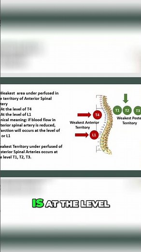 Antero-Sphinal Artery Infarction: T4 & L1 Explained #shorts