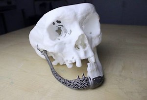 3D Gens first Malaysian company to produce patient specific bone implants