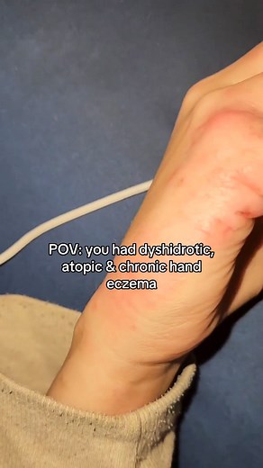 If you’ve ever dealt with chronic hand eczema, you know how relentless it can be - the itching, the cracks, the pain that makes even washing your hands feel impossible. 💔 Dyshidrotic, atopic or contact eczema - whatever the type, the goal is the same: repair the skin barrier and calm inflammation. Consistency is everything. Daily hydration, barrier support and gentle care can completely transform your skin - even when it feels impossible. 🌿💧 #handeczema #dyshidroticeczema #atopiceczema #eczem