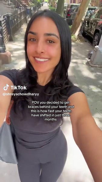 Three Month Braces Transformation: Lingual Braces Behind Your Teeth