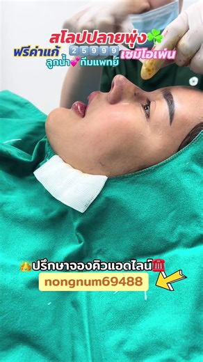 เสริมจมูกเทคนิค 𝑭𝒖𝒍𝒍 𝑶𝒑𝒕𝒊𝒐𝒏 เนื้อเยื้อX3 โปรโมชั่นราคา 25,999 บาท จองโปรโมชั่น ฟรีค่าแก้ 999 บาท เก็บสิทธิ์ได้6เดือน *แถมเนื้อเยื่อเทียม1ชั้น 🔅สิ่งที่คนไข้จะได้รับในโปรนี้🔅 ✅ซิลิโคนพรีเมี่ยมเคโอซาน ✅เทคนิคเซมิโอเพ่น ✅เทคนิคเย็บอินเตอร์โดม ✅เทคนิคตอกฐานกระดูก(แก้ปัญหาเบี้ยวเอียงได้ดี) ✅เทคนิคยืดผนังกั้น ✅เทคนิคตะไบฐานกระดูก ✅เทคนิครองปลายเนื้อเยื่อx3 -เทคนิครองปลายเนื้อเยื่อเทียม2ชั้น - เทคนิครองปลายเนื้อเยื่อผังผืด {เฉพาะเคสแก้} ✅เทคนิคตะไบฮัมพ์ พื้นฐาน ✅เทคนิคการเย็บแผล แบบซ่อนแผลเป
