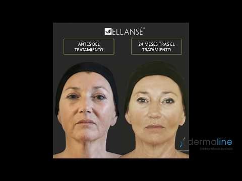 Antes y Después - Ellansé en Clínica Dermaline