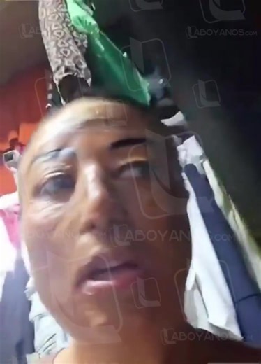 Le explotó su telefono celular Una mujer llamada Yady resultó grav3mente h3rida cuando su celular expl0tó mientras dormía. Ella explicó que el dispositivo estaba cargando sobre la almohada y se recalentó, provocando un corto que generó la expl0sión. El impacto le causó quem4duras de segundo y tercer grado y pérdida de conocimiento. Su testimonio se viralizó en redes sociales para advertir a otros sobre este peligr0 cotidiano. Expertos y autoridades aconsejan no cargar teléfonos sobre camas o sup