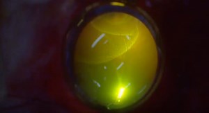 Chandelier-Assisted Scleral Buckling With Subretinal Fluid Drainage - Eyetube