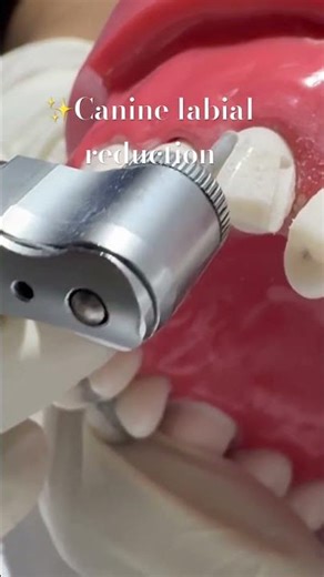 🦷 Canine Labial Reduction – The Key to Perfect Crown Contour ✨| Dr.Dentique-hub
