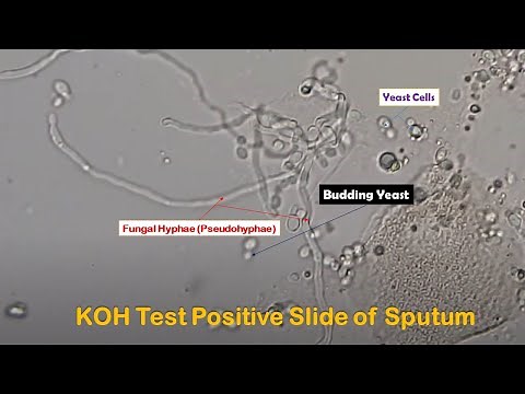 KOH Positive showing Fungal elements yeast cells, budding and pseudohyphae in Sputum sample