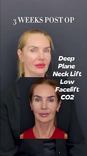 Deep Plane Neck Lift, Low Face Lift, CO 2 with Board Certified Facial Plastic Surgeon Dr.Zhuravsky