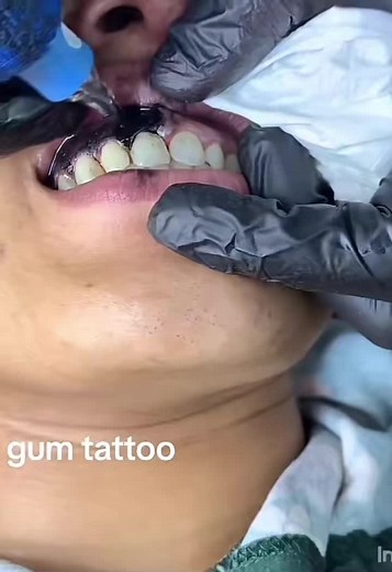 Black Gum Tattoo Now Available - Microblending Before and After