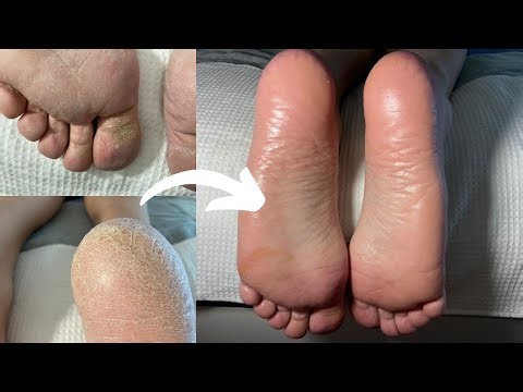 Satisfying Callus Removal From Feet | Cleaning And Massage | No Talking