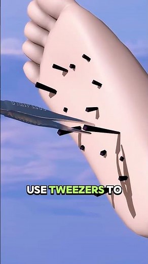 Stepped on a Sea Urchin? Do THIS Immediately!