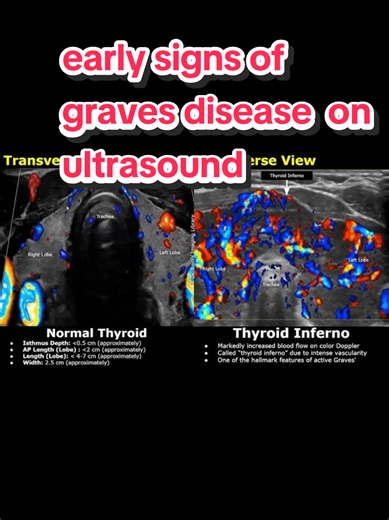 early signs of Graves disease#TikTokCreatorSearchInsightsIncentive #gravedisease #thyroidproblems #thyroidhealth #ultrasound