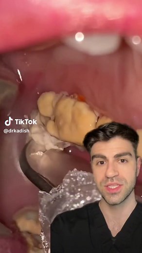 Dental Hygiene: Severe Build Up on Wisdom Teeth