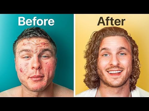 How I FINALLY Got Rid of My Acne!