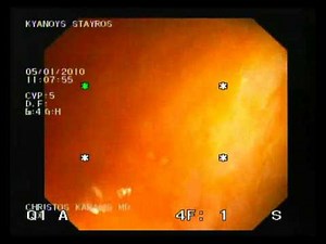 Ileocecal Valve Intubation • Video • MEDtube.net