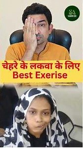 Bell’s Palsy Exercises | Face Paralysis Recovery Fast (Ayurveda + Homeopathy)